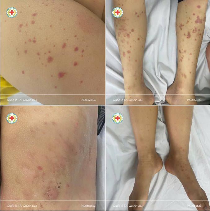 ⚠️ SCHÖNLEIN – HENOCH: CÓ THỂ NHẸ… NHƯNG CŨNG CÓ THỂ DIỄN TIẾN PHỨC TẠP