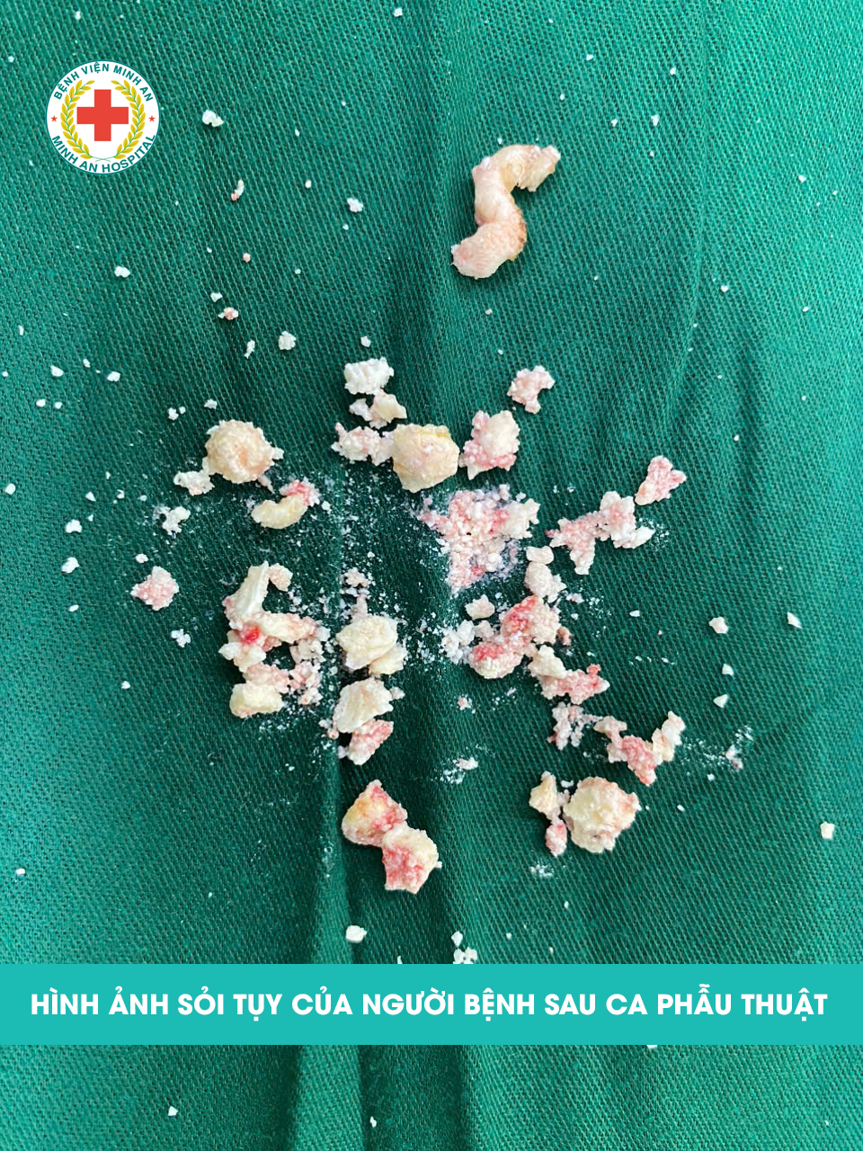 PHẪU THUẬT KỊP THỜI CỨU CHỨC NĂNG TỤY CHO BỆNH NHÂN TẮC MẬT – SỎI TỤY – VIÊM TỤY MẠN