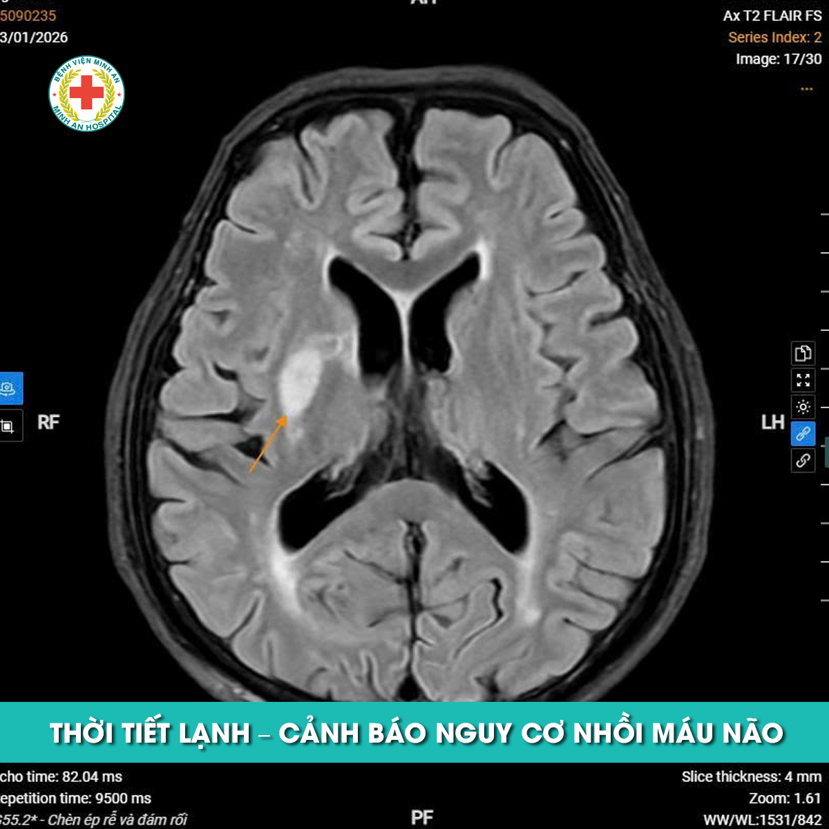 THỜI TIẾT LẠNH – CẢNH BÁO NGUY CƠ NHỒI MÁU NÃO