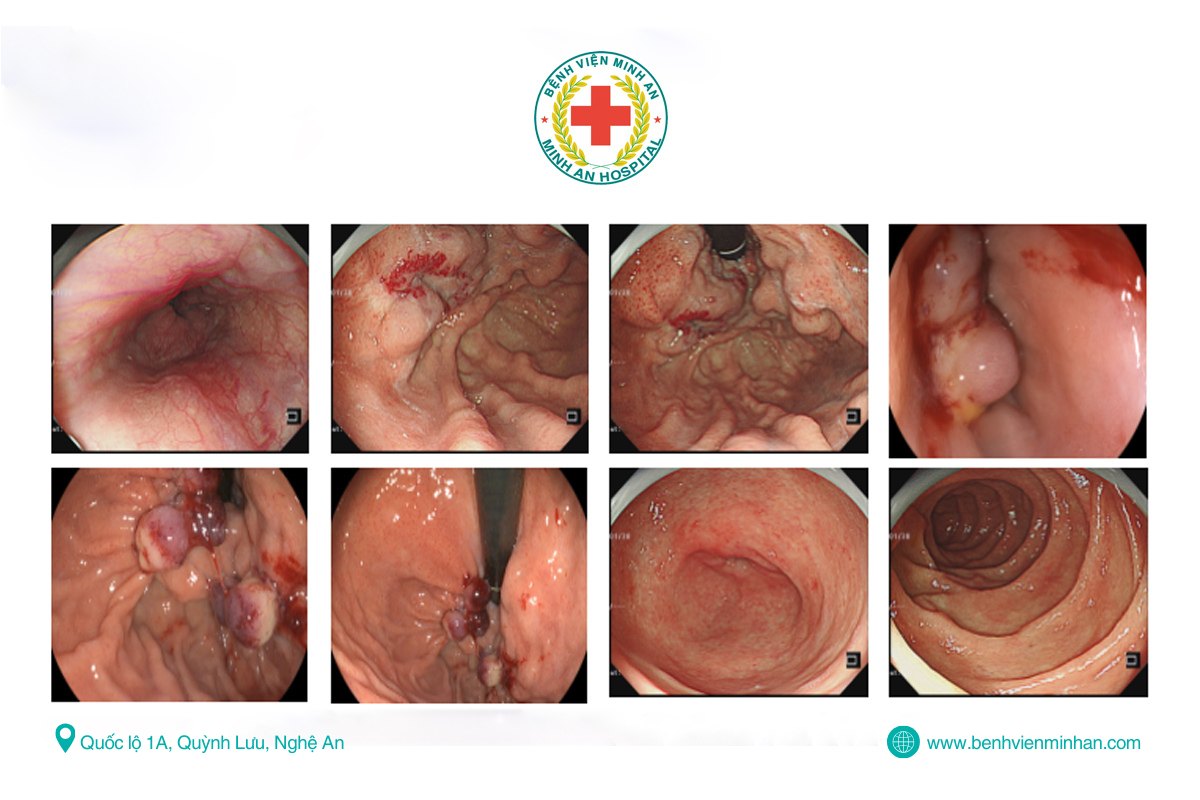 NỘI SOI CAN THIỆP KỊP THỜI – NGĂN CHẶN NGUY CƠ CHẢY MÁU TIÊU HÓA NGHIÊM TRỌNG