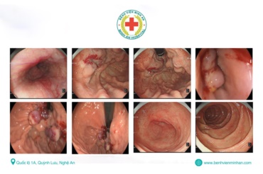 NỘI SOI CAN THIỆP KỊP THỜI – NGĂN CHẶN NGUY CƠ CHẢY MÁU TIÊU HÓA NGHIÊM TRỌNG
