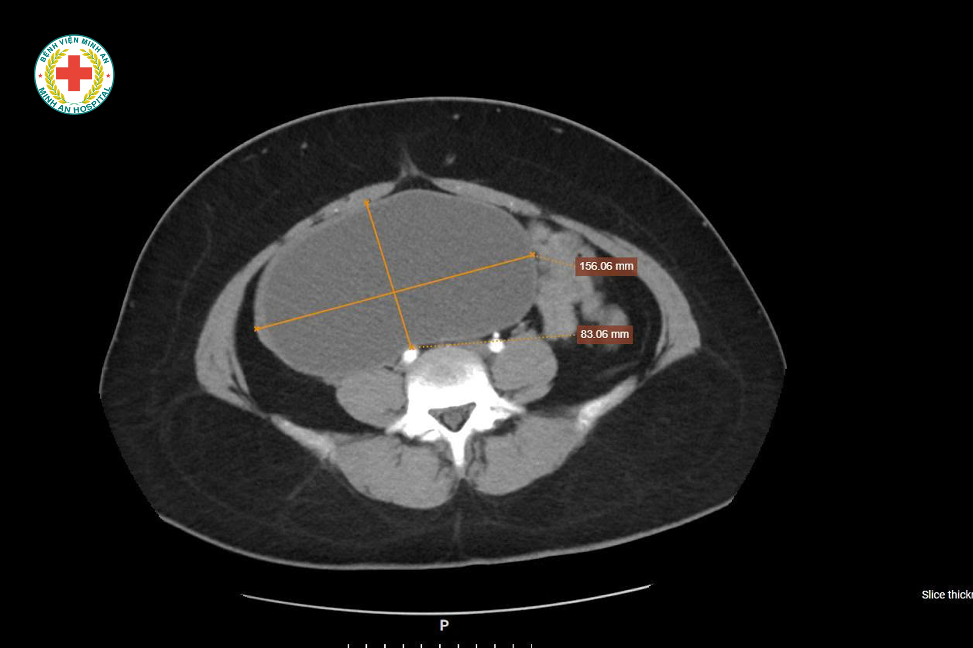 🔴 U NANG BUỒNG TRỨNG “KHỔNG LỒ” Ở CÔ GÁI 22 TUỔI – PHÁT HIỆN TÌNH CỜ, XỬ TRÍ KỊP THỜI, BẢO TỒN KHẢ NĂNG SINH SẢN