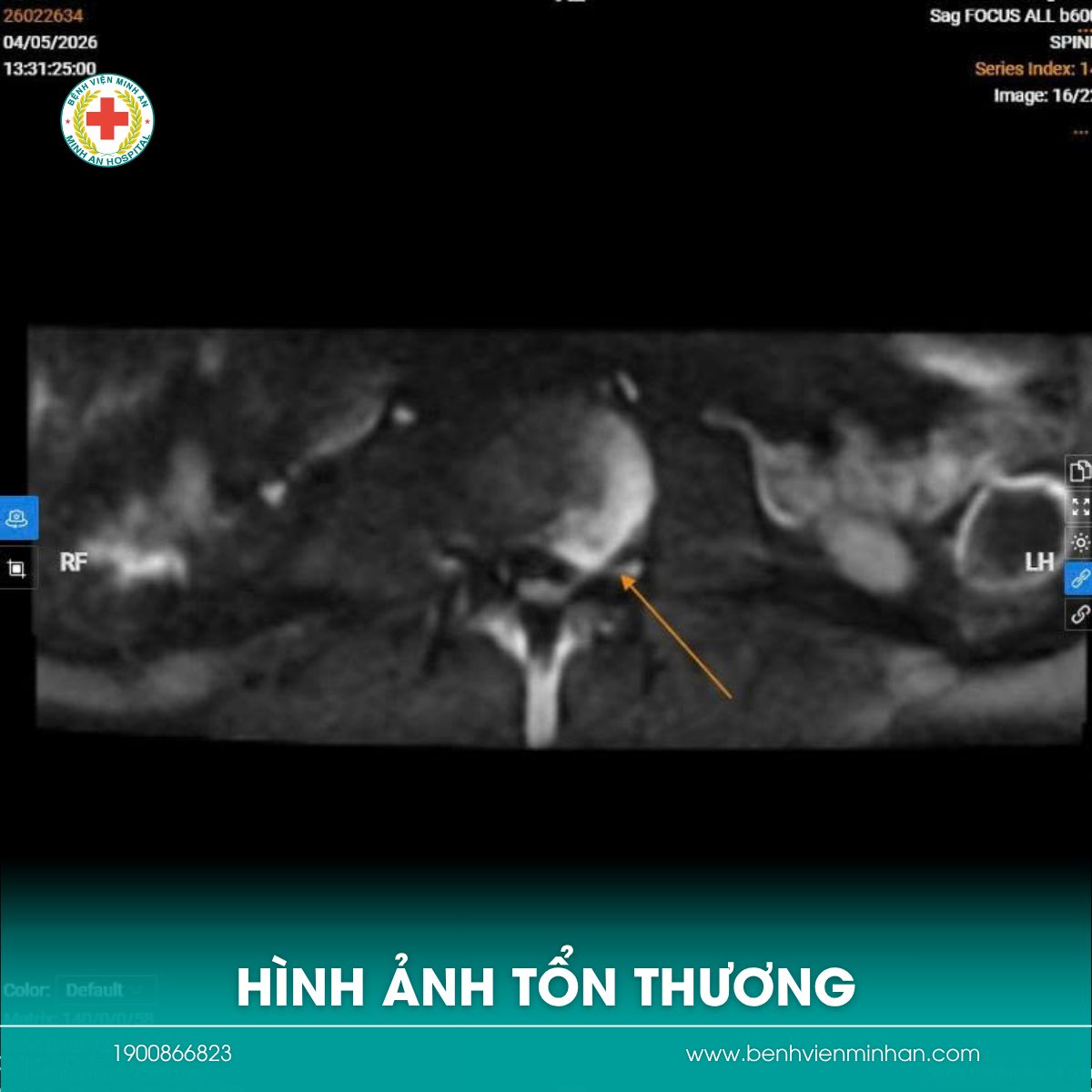 ⚠️ ĐAU THẮT LƯNG KÉO DÀI, ĐIỀU TRỊ NHIỀU NƠI KHÔNG ĐỠ – NGƯỜI PHỤ NỮ 39 TUỔI PHÁT HIỆN TỔN THƯƠNG NGHI LAO CỘT SỐNG
