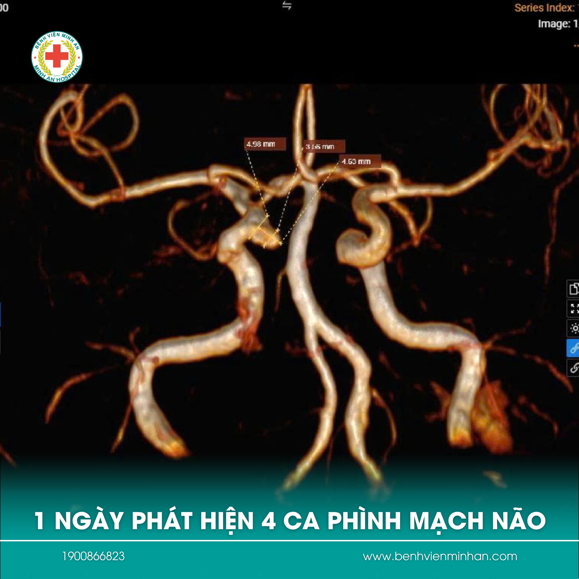 🧠 PHÁT HIỆN 4 CA PHÌNH MẠCH NÃO CHỈ TRONG 1 NGÀY