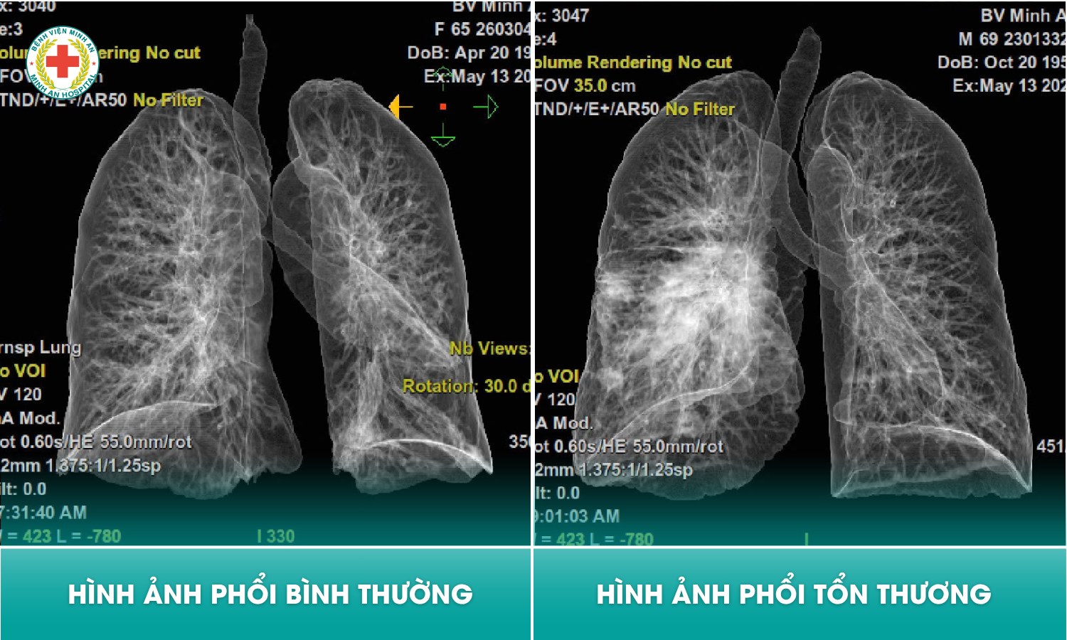 ⚠️ CT SCANNER 128 LÁT CẮT – “TẤM BẢN ĐỒ” GIÚP PHÁT HIỆN SỚM NHỮNG TỔN THƯƠNG PHỔI KHÓ NHẬN BIẾT
