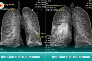 ⚠️ CT SCANNER 128 LÁT CẮT – “TẤM BẢN ĐỒ” GIÚP PHÁT HIỆN SỚM NHỮNG TỔN THƯƠNG PHỔI KHÓ NHẬN BIẾT
