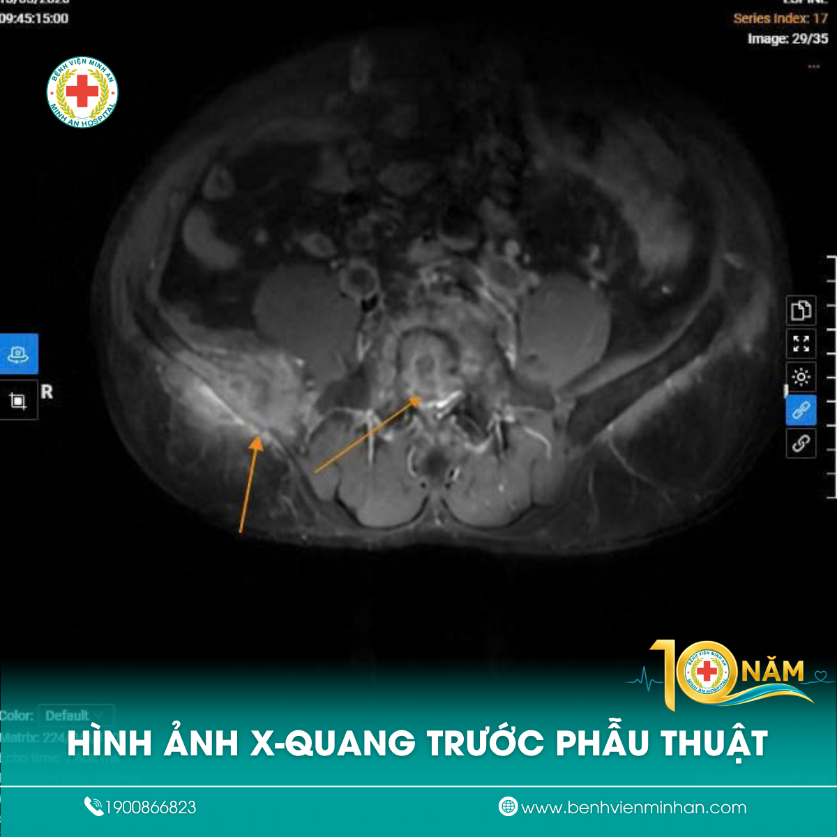 💙 ĐAU LƯNG 1 THÁNG KHÔNG ĐỠ, NGƯỜI ĐÀN ÔNG 67 TUỔI PHÁT HIỆN TỔN THƯƠNG NGHI NGỜ ÁC TÍNH TỪ MRI 3.0 TESLA