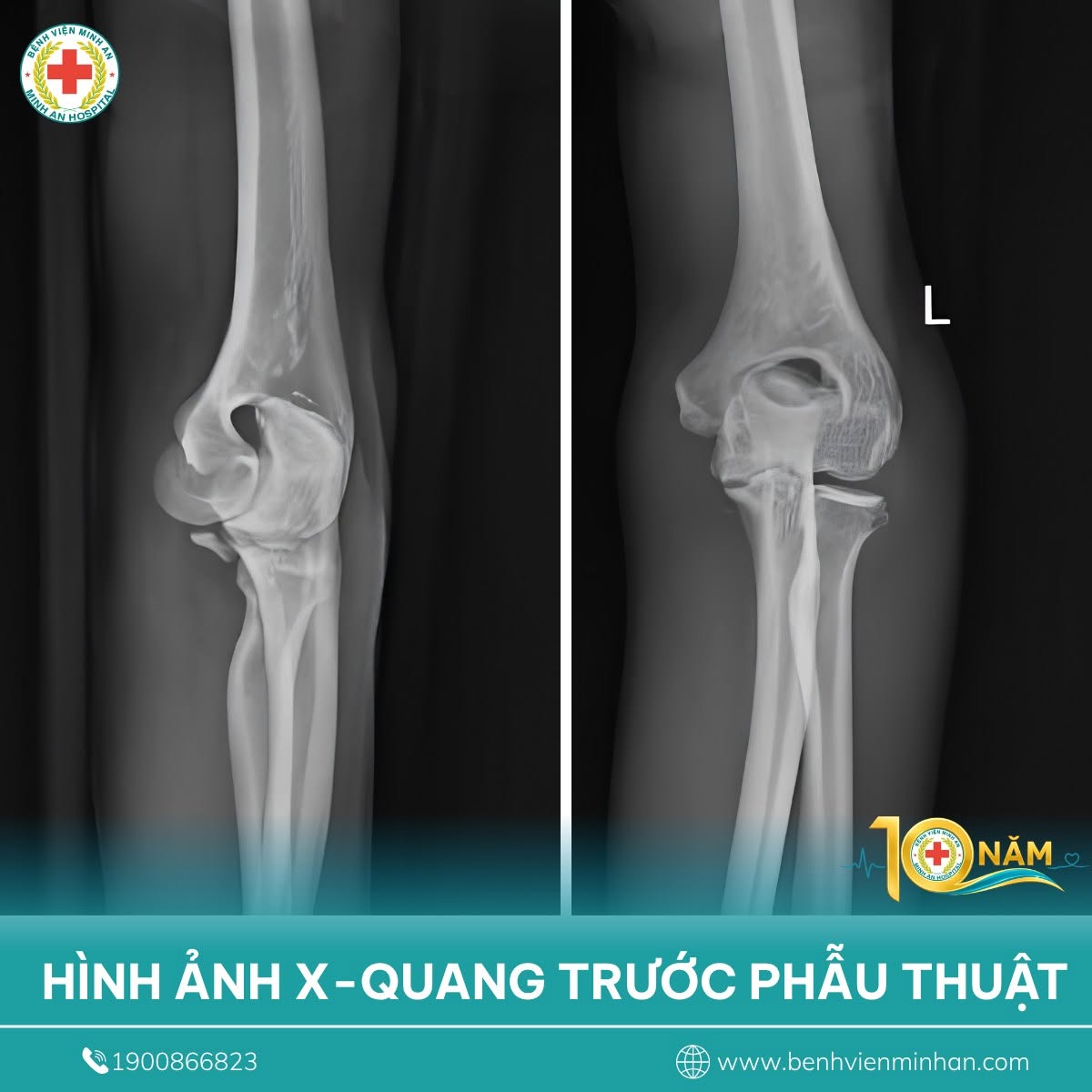 🏥 PHẪU THUẬT THÀNH CÔNG CHO BỆNH NHÂN TRẬT KHỚP KHUỶU KÈM GÃY MỎM VẸT XƯƠNG TRỤ DO TAI NẠN GIAO THÔNG