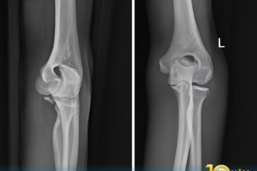 🏥 PHẪU THUẬT THÀNH CÔNG CHO BỆNH NHÂN TRẬT KHỚP KHUỶU KÈM GÃY MỎM VẸT XƯƠNG TRỤ DO TAI NẠN GIAO THÔNG