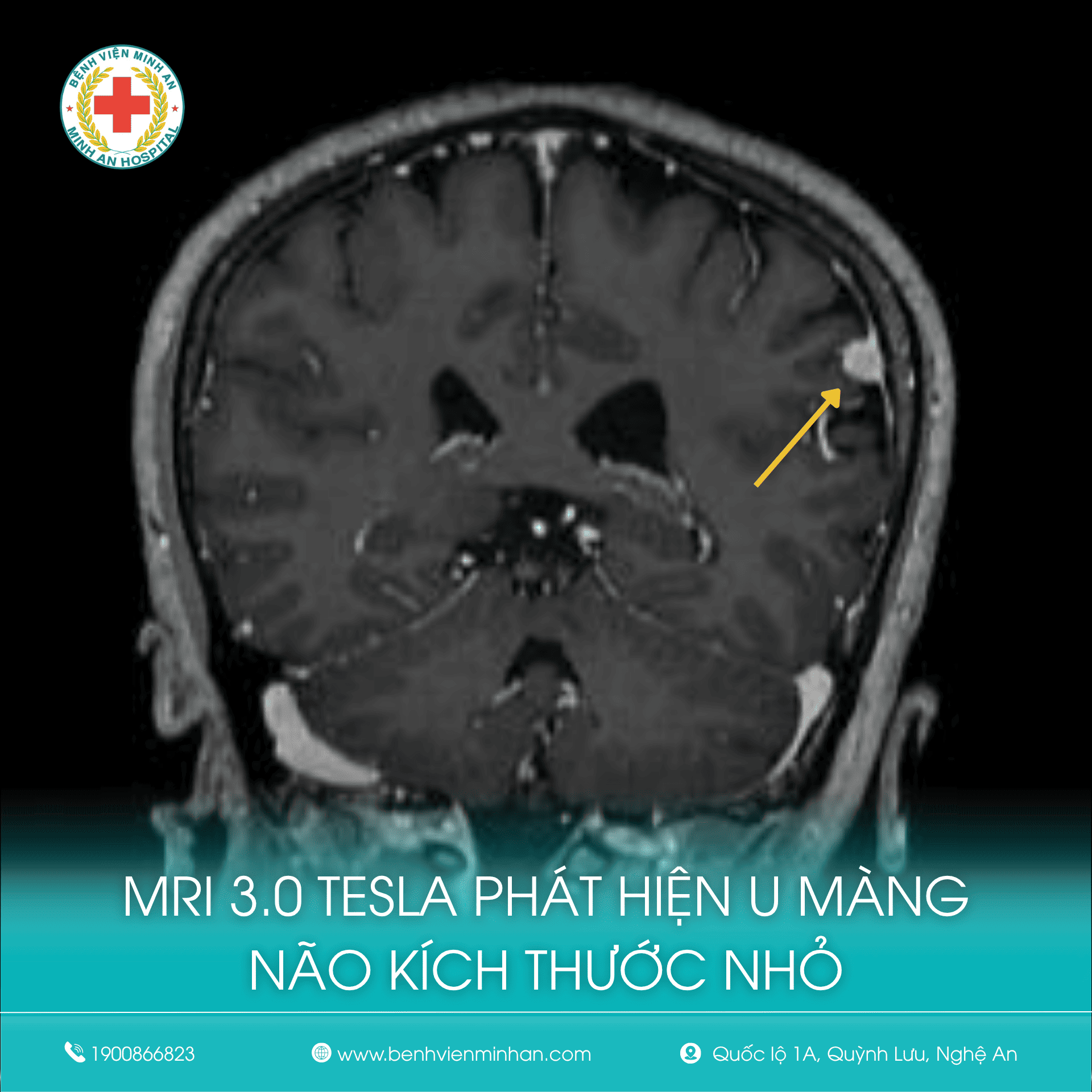 ​MRI 3.0 TESLA HỖ TRỢ PHÁT HIỆN SỚM U MÀNG NÃO Ở NGƯỜI BỆNH ĐAU ĐẦU, CHÓNG MẶT KÉO DÀI