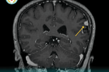 ​MRI 3.0 TESLA HỖ TRỢ PHÁT HIỆN SỚM U MÀNG NÃO Ở NGƯỜI BỆNH ĐAU ĐẦU, CHÓNG MẶT KÉO DÀI